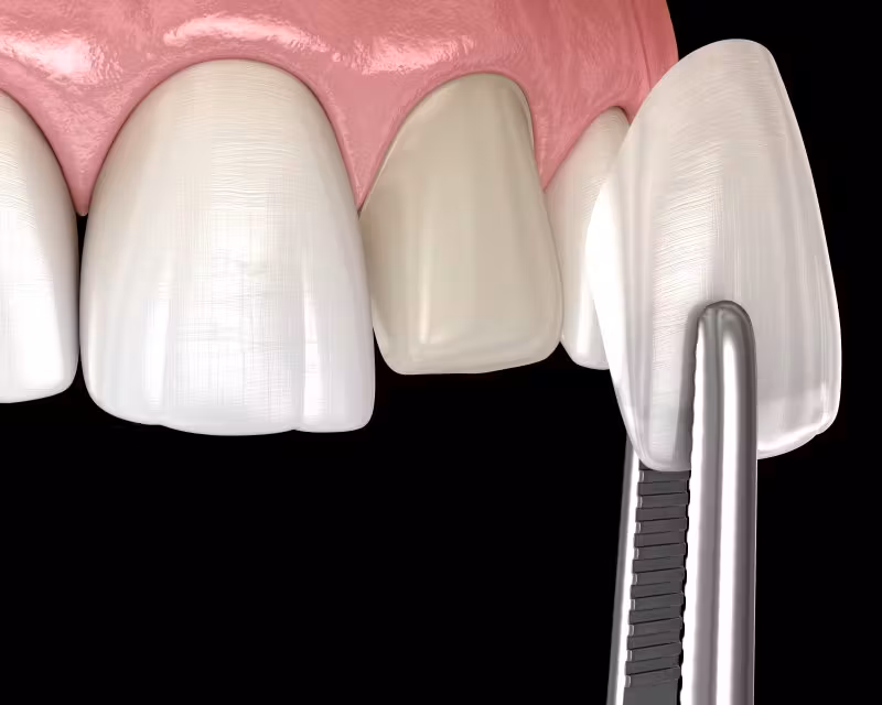 teeth veneers
