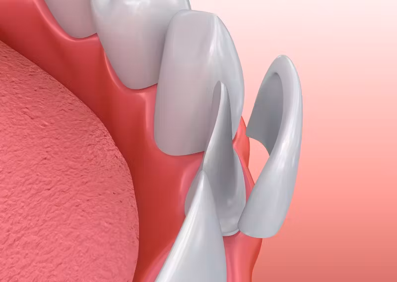 teeth veneers