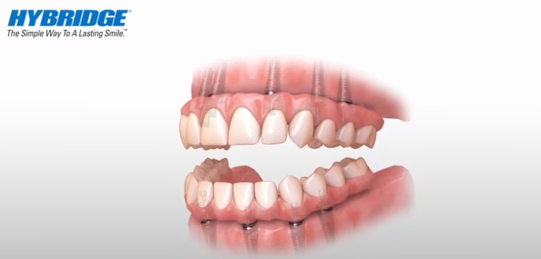 Start Your All-on-X Treatment